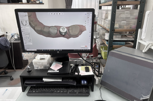 歯科技工専用CADソフトによる補綴物設計画面